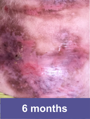Abdomen of a VYJUVEK® patient after treatment