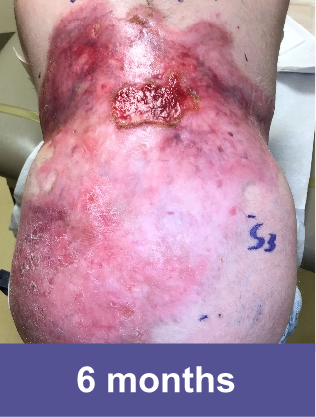 A wound on back of a VYJUVEK® patient after 6 months of treatment