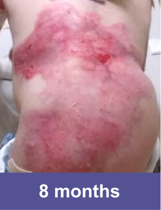 A wound on back of a VYJUVEK® patient after 8 months of treatment