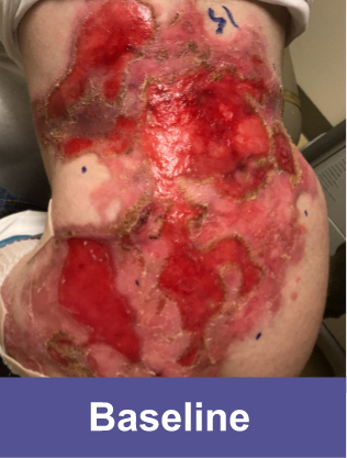 A wound on back of a VYJUVEK® patient before treatment