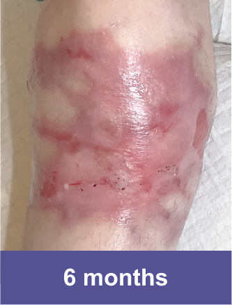 Knee of a VYJUVEK® patient after treatment