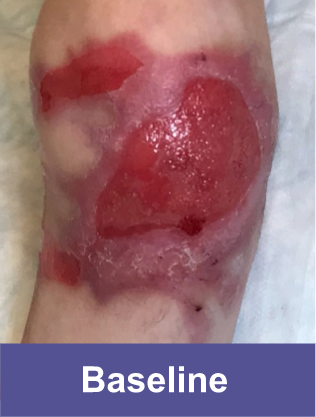 Knee of a VYJUVEK® patient before treatment