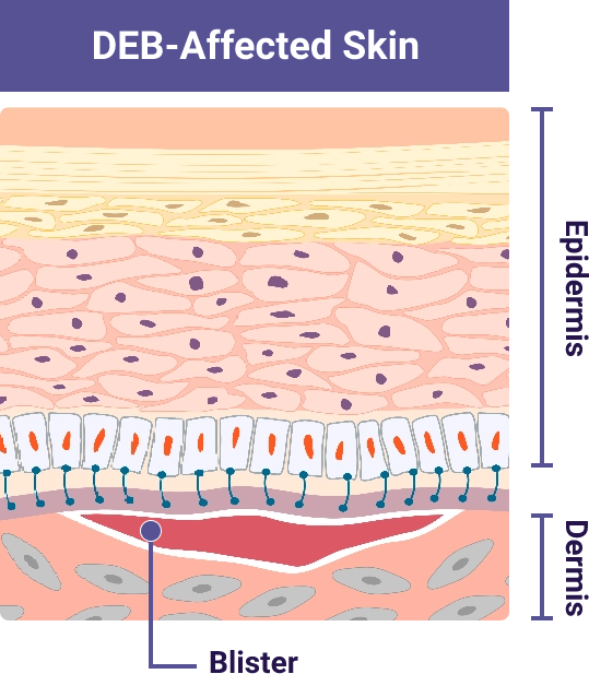 Skin affected by DEB